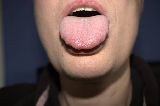 Fordyce Spots (White Bumps) On Lips: Symptoms, Causes, Treatments & Risk Factors