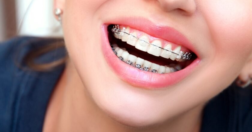 Everything You Need to Know Before Getting Braces